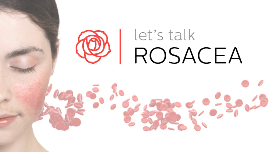 Let’s talk Rosacea