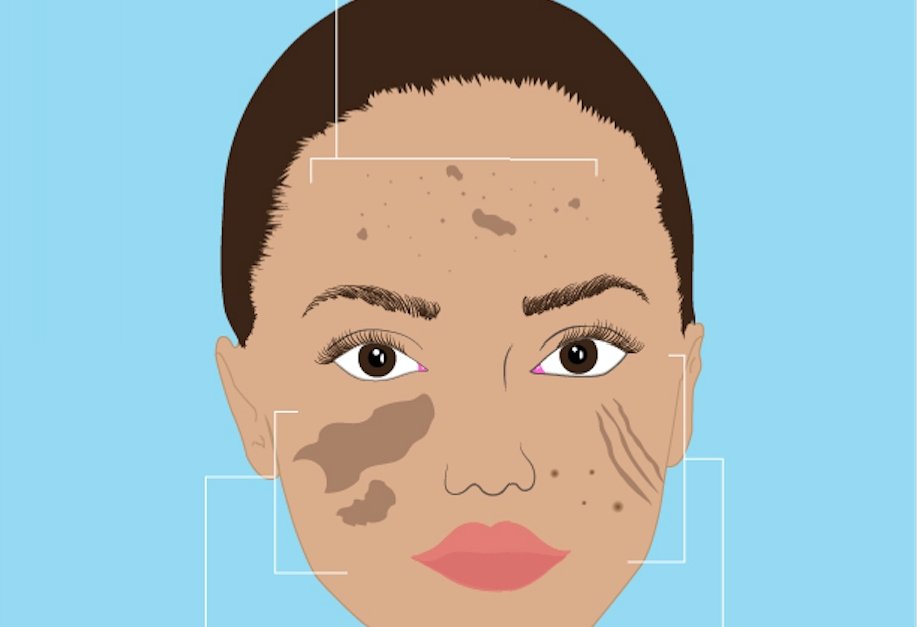 Infographic: What is this dark spot/patch on my face?! | XTETIC