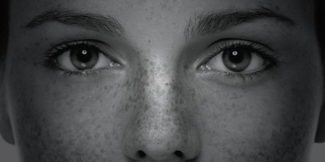 Treating Pigmentation With TDS! | XTETIC